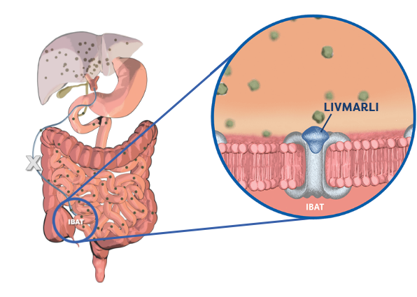 Mechanism of Action With Ileal Bile Acid Transporter (IBAT) Inhibition