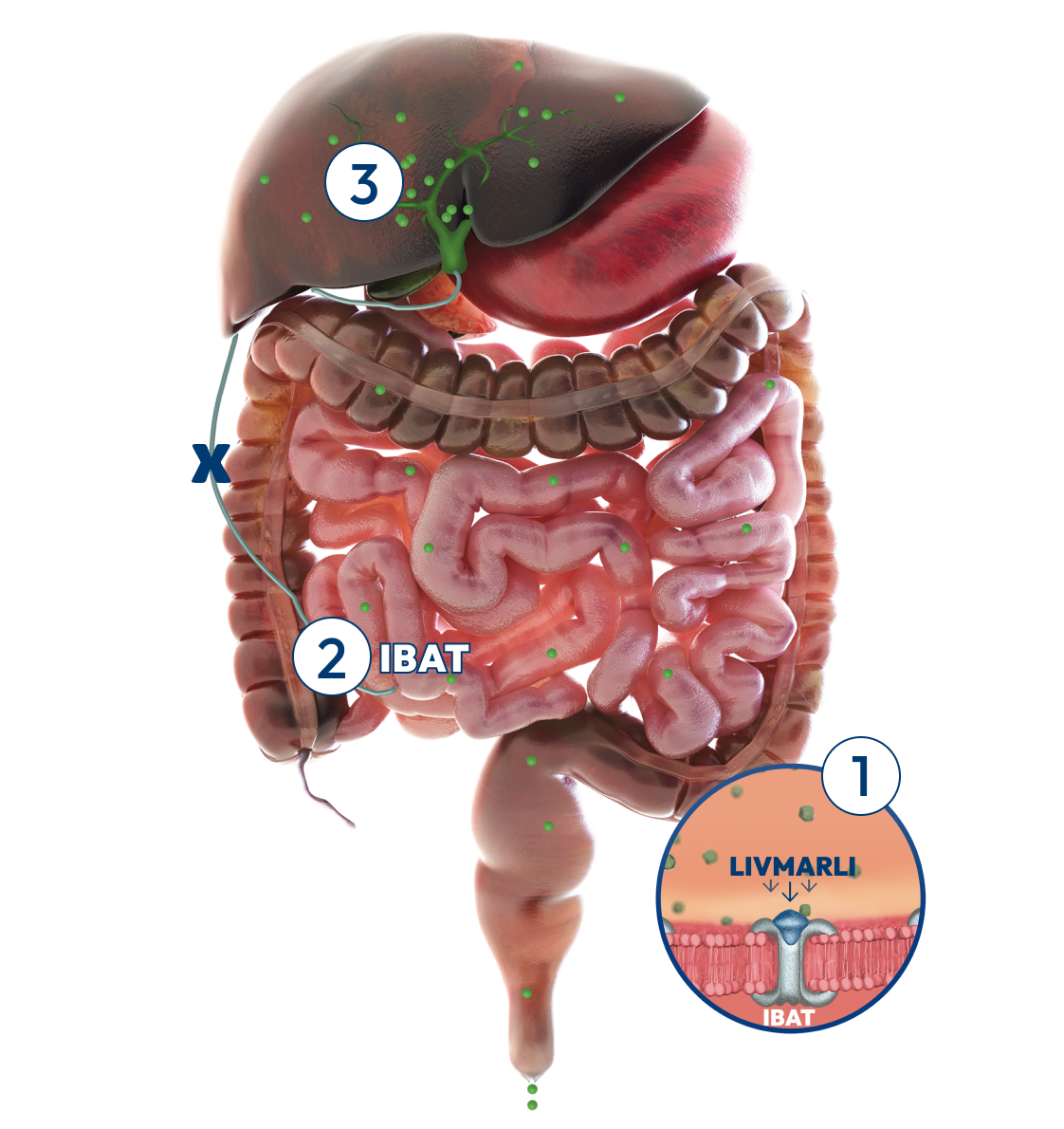 Liver with intestines, number 1 shows LIVMARLI targeting IBAT, number 2 shows LIVMARLI removing bile acids, number 3 shows reductions in bile acids